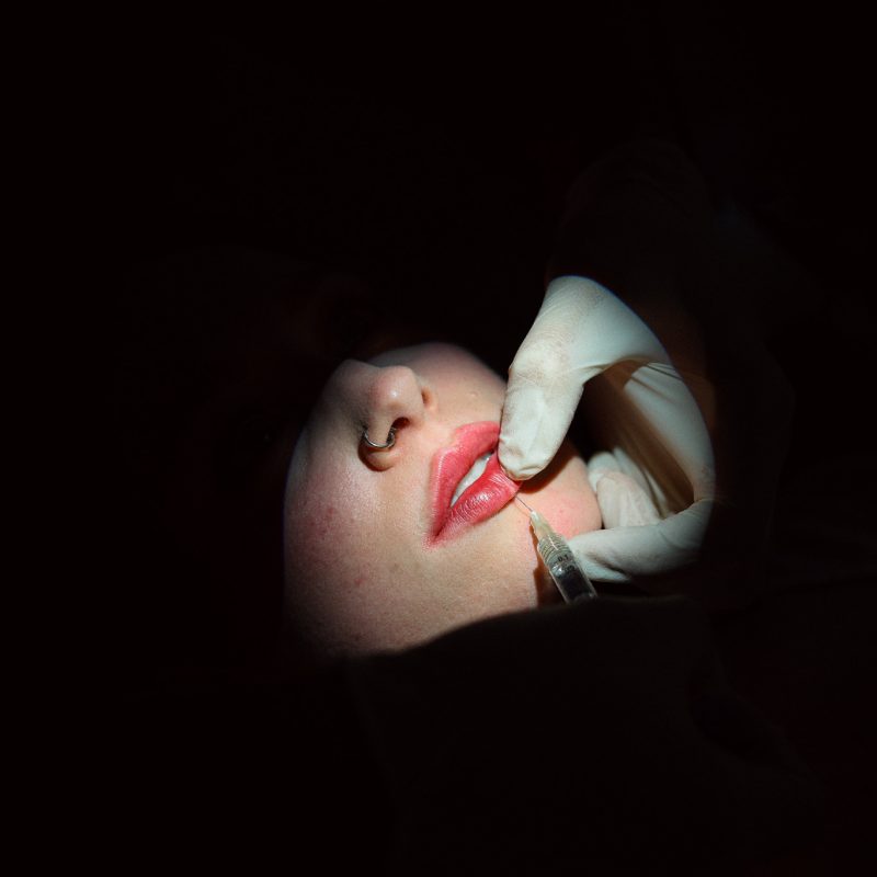 Filler e botulino_1